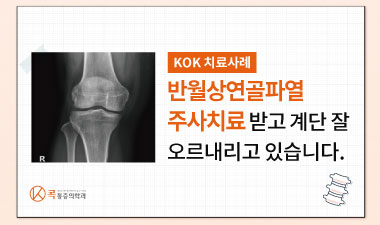  계단 오를때 무릎통증으로 고생하다 반월상연골파열 진단받은 환자사례