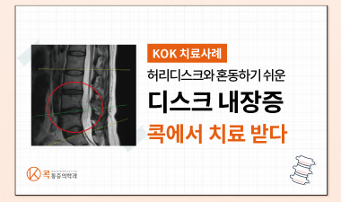 허리디스크와 혼동하기 쉬운 ‘디스크내장증’ 콕에서 치료받았습니다.