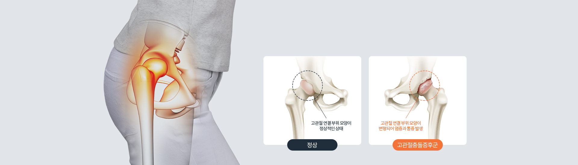 정상 환자의 60%는 보존적 치료로 호전 가능! 고관절충돌증후군 고관절 연결 부위 모양이 변형되어 염증과 통증 발생