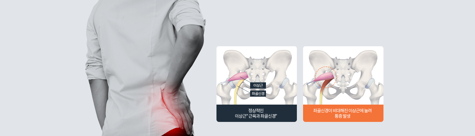 정상적인 “이상근” 근육과 좌골신경 좌골신경이 비대해진 이상근에 눌려 통증 발생