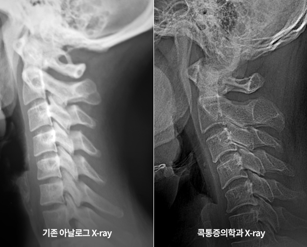 첨단 디지털 X-RAY