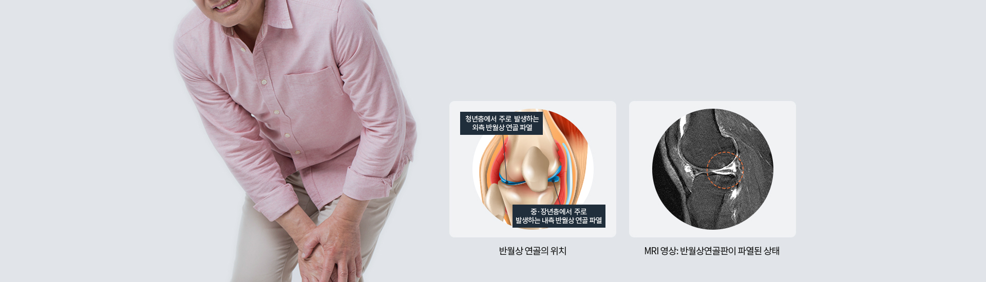 청년층에서 주로 발생하는 외측 반월상 연골 파열 중·장년층에서 주로 발생하는 내측 반월상 연골 파열 반월상 연골의 위치 MRI 영상: 반월상연골판이 파열된 상태